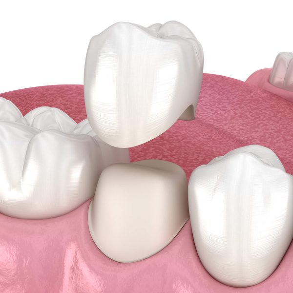 Don't Wait! Repair Damaged Teeth With CEREC Same-Day Dental Crowns